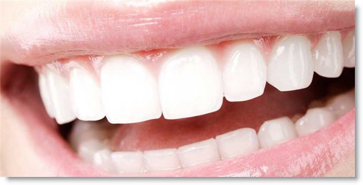 Blancorexia dental y sus peligros